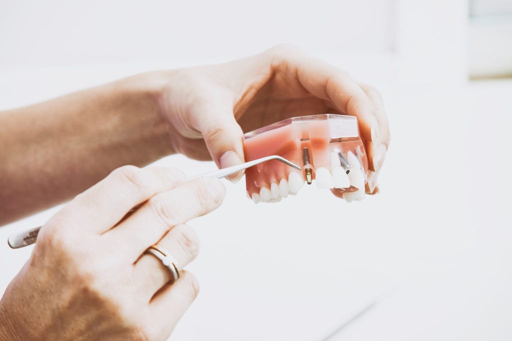 Dental Implants