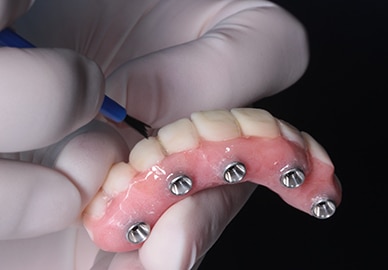 Implant supported overdentures